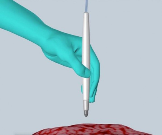 تشخیص سرطان در ۱۰ ثانیه با یک قلم